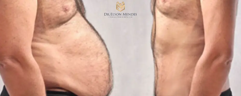 Tratamento de Obesidade